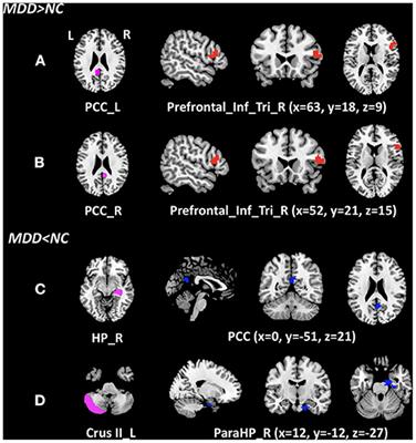 Abnormal Functional Connectivity of Posterior Cingulate Cortex Correlates With Phonemic Verbal Fluency Deficits in Major Depressive Disorder